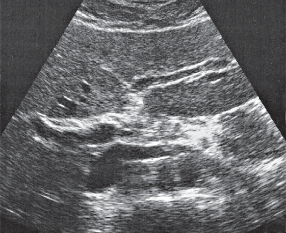 Left renal vein ultrasound image, Medial and anterior hepatic segments, right and left portal vein branches