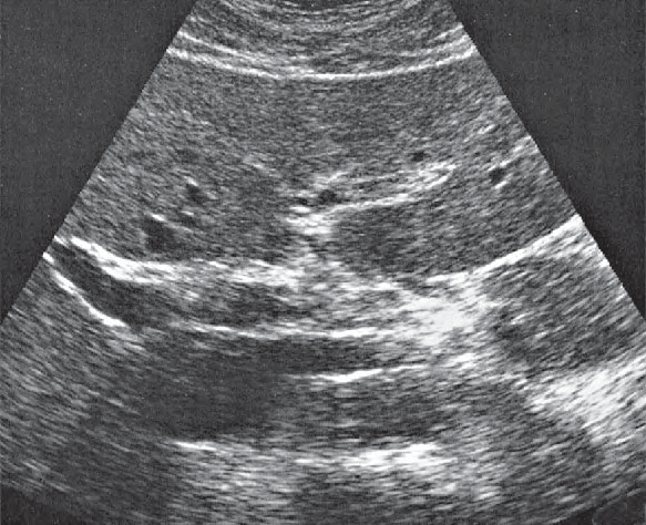 Quadrate lobe ultrasound image, Medial and anterior hepatic segments, right and left portal vein branches