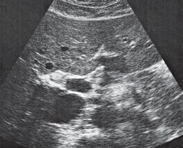 Quadrate lobe ultrasound image, Medial and anterior hepatic segments, quadrate lobe, ligamentum teres, portal vein