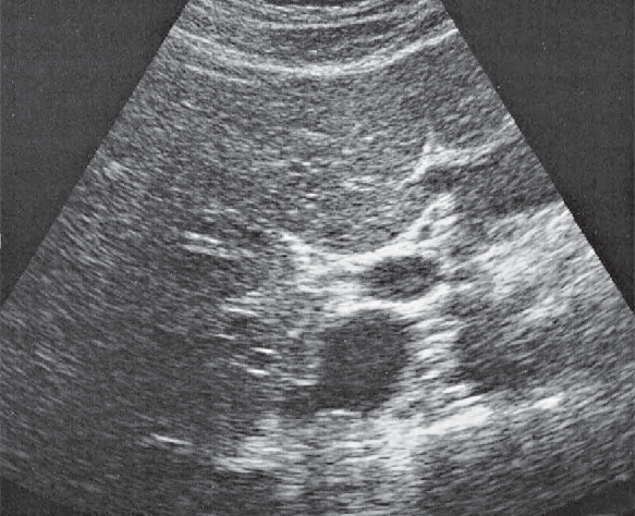 Duodenum ultrasound image, Medial and anterior hepatic segments, quadrate lobe, ligamentum teres, portal vein