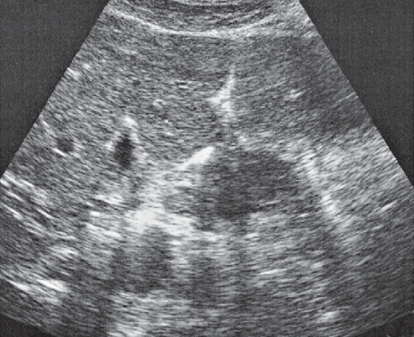 Duodenum ultrasound image, Medial and anterior hepatic segments, quadrate lobe, ligamentum teres, gallbladder