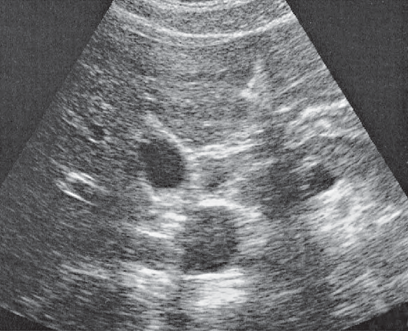 Gallbladder ultrasound image, Medial and anterior hepatic segments, quadrate lobe, ligamentum teres, gallbladder
