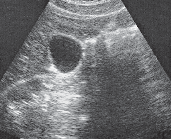Posterior segment ultrasound image, Inferior border of liver, kidney, gallbladder, ligamentum teres
