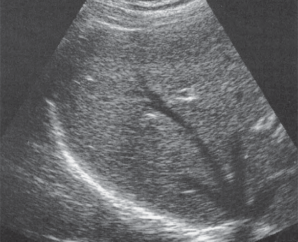 Posterior segment ultrasound image, Posterior segment, cranial subsegment