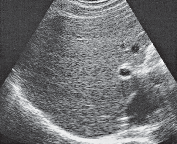 Posterior segment ultrasound image, Posterior segment, portal vein