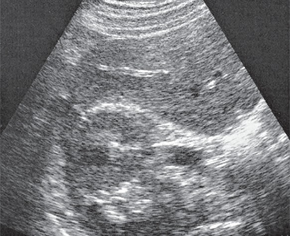 Posterior segment ultrasound image, Posterior segment, caudal subsegment, kidney